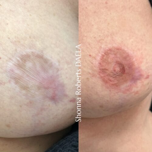 Areola Restoration Tattoo at DAELA by Shonna