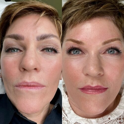 Laser Removal and Reapplication