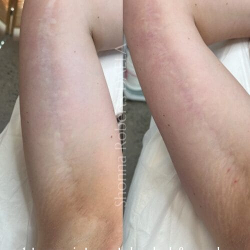 Scar Camouflage in Portland at DAELA by Shonna