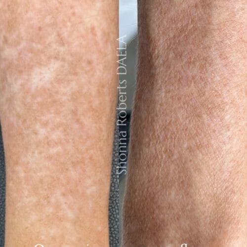 Scar Camouflage in Portland at DAELA by Shonna