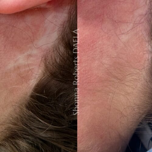 Scar Camouflage in Portland at DAELA by Shonna