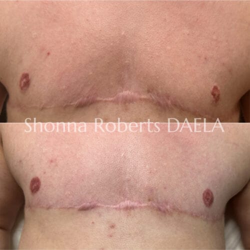 Top Surgery Areola Restoration Tattoo