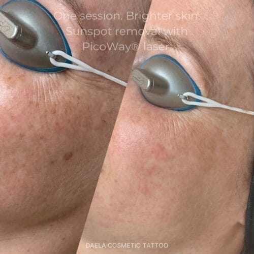 Laser Facials at DAELA Portland