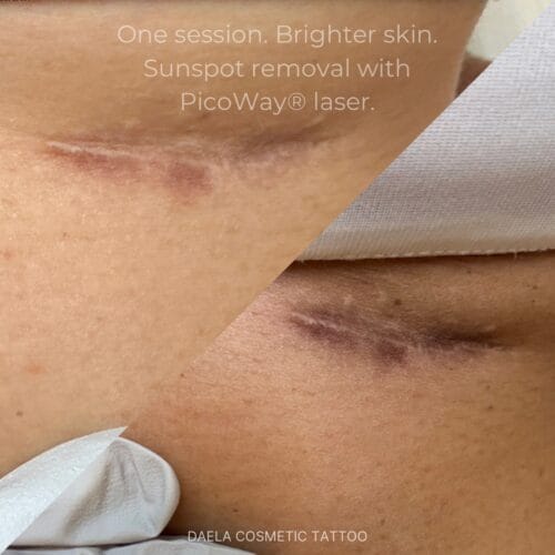 Laser Facials at DAELA Portland