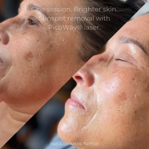 Laser Facials at DAELA Portland