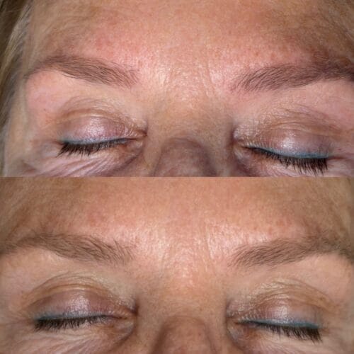 Laser Brow Tattoo Removal at DAELA Portland