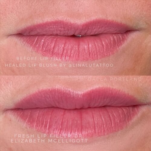 Lip Filler by Dr Elizabeth McElligott