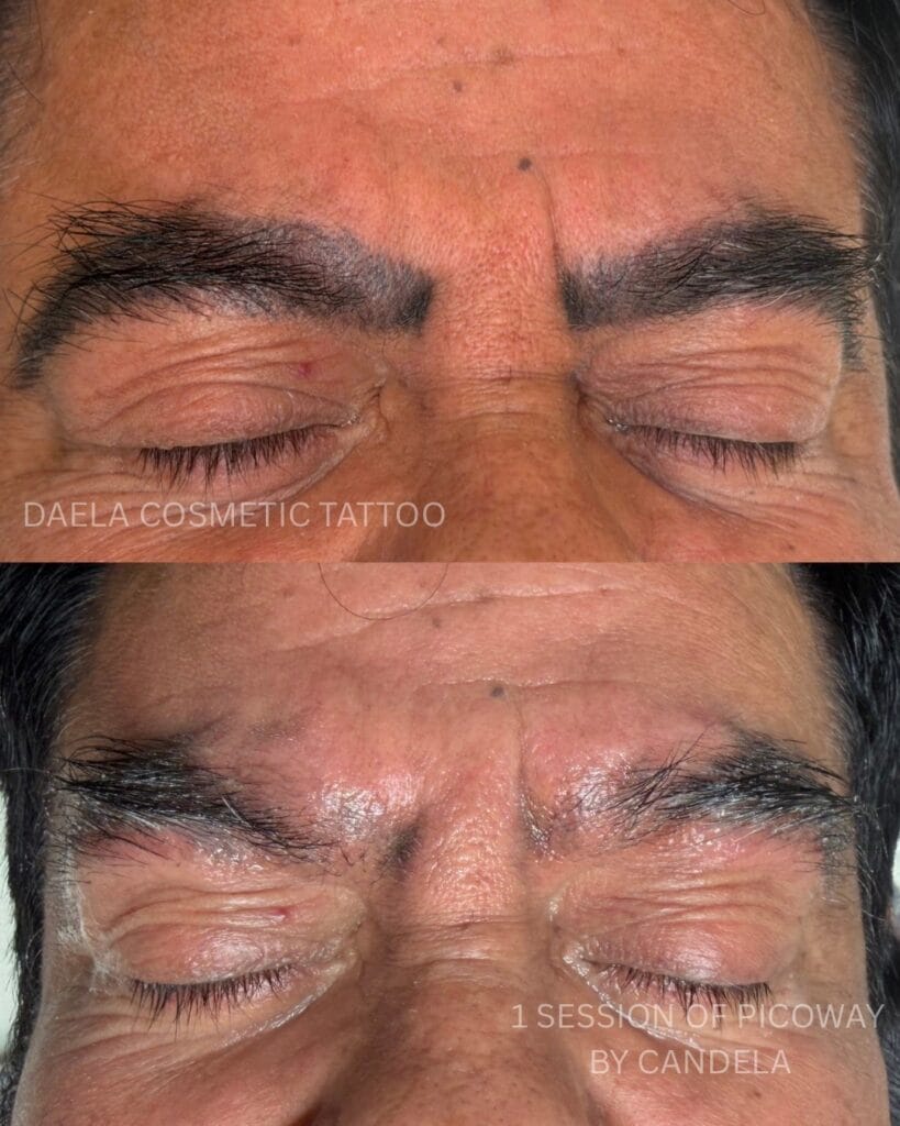 Laser PMU Removal DAELA Cosmetic Tattoo