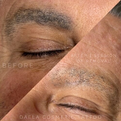 Laser PMU Removal DAELA Cosmetic Tattoo