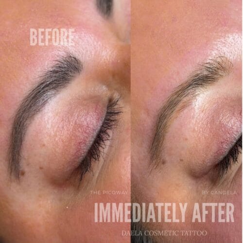 Laser PMU Removal at DAELA