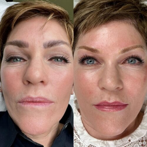 Laser PMU Removal at DAELA