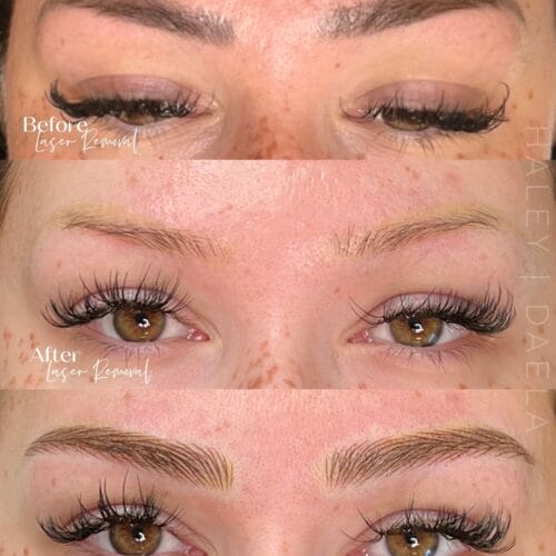 Laser PMU Removal at DAELA