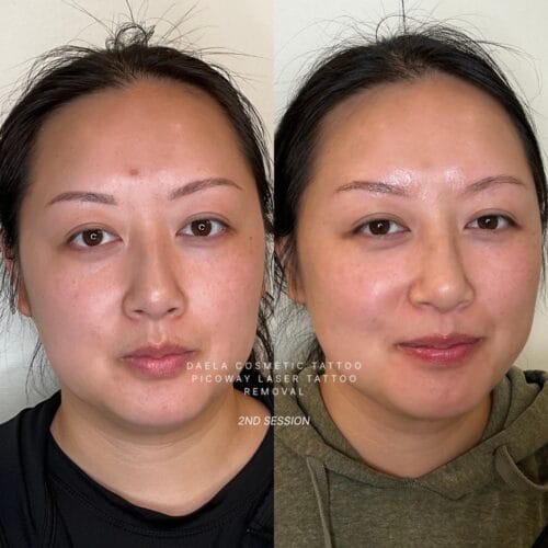 Laser PMU Removal at DAELA