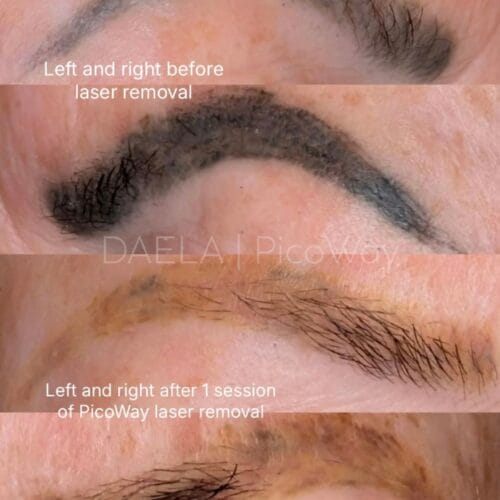 Laser PMU Removal at DAELA