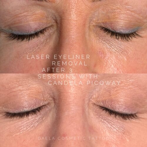 Laser Eyeliner Tattoo Removal at DAELA