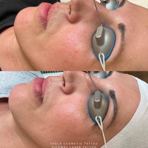 Laser PMU Removal at DAELA