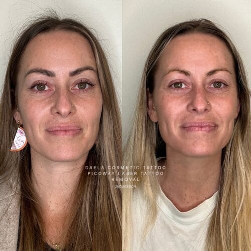 Laser PMU Removal at DAELA