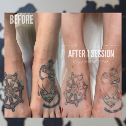 Laser tattoo Removal at DAELA