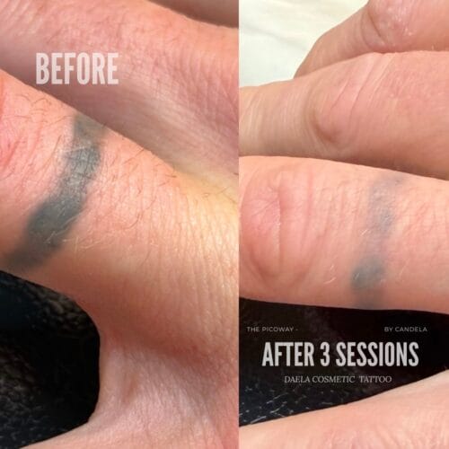 Laser tattoo Removal at DAELA