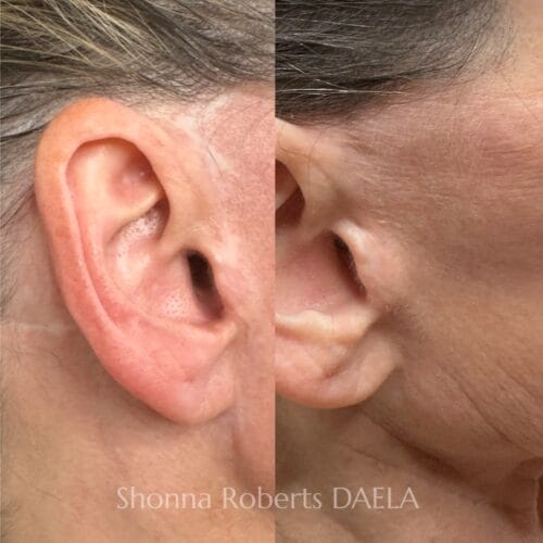 Scar Camouflage Tattoo in Portland