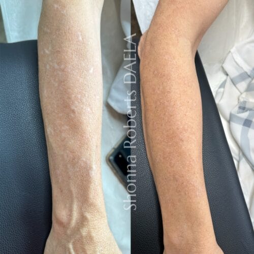 Scar Camouflage Tattoo in Portland