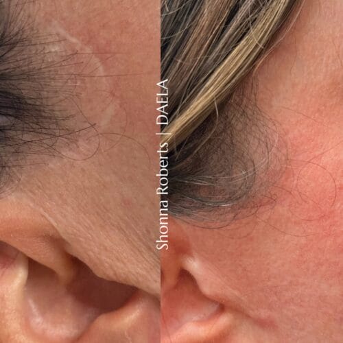 Scar Camouflage Tattoo in Portland