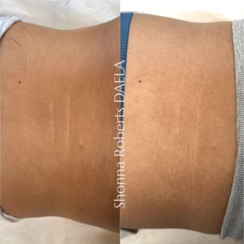 Stretch Mark Revision DAELA portland