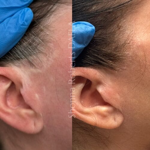 Scar Camouflage Tattoo in Portland