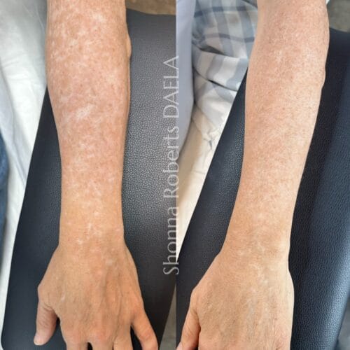 Scar Camouflage Tattoo in Portland