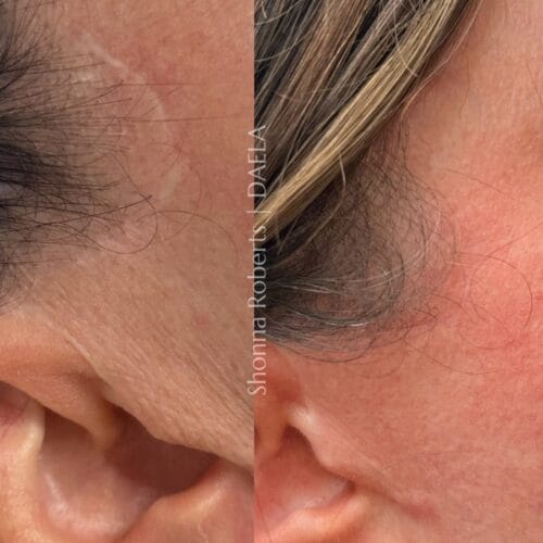 Scar Camouflage Tattoo in Portland