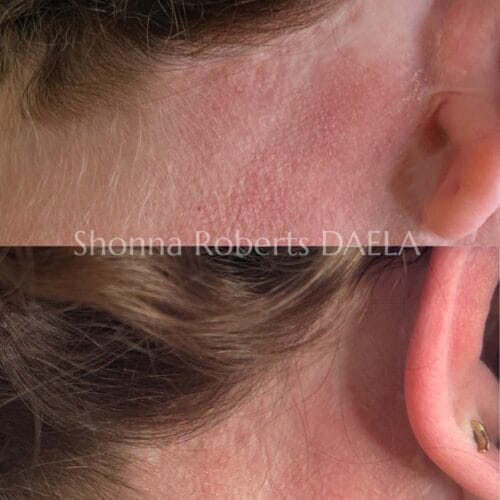 Scar Camouflage Tattoo in Portland