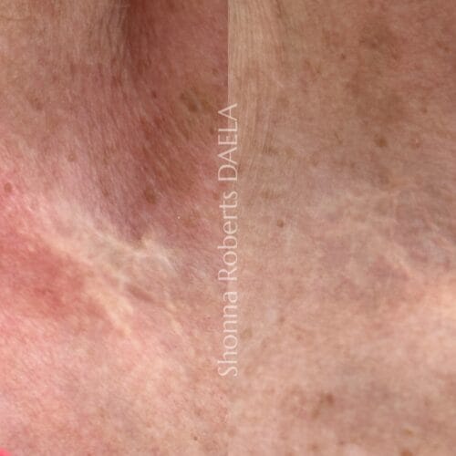 Scar Camouflage Tattoo in Portland