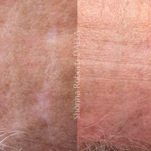 Scar Camouflage Tattoo in Portland