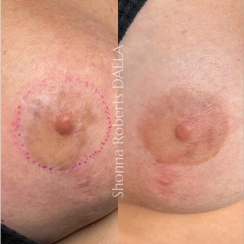 Areola Restoration Tattoo in Portland Oregon