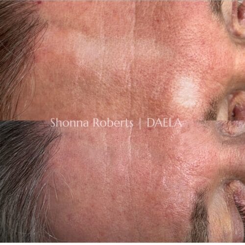 Scar Camouflage Tattoo in Portland