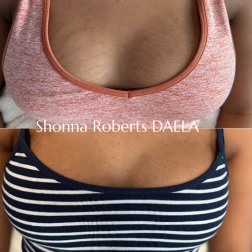 Stretch mark Revision DAELA Portland