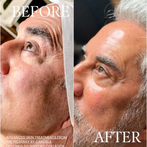 brown spot removal at daela