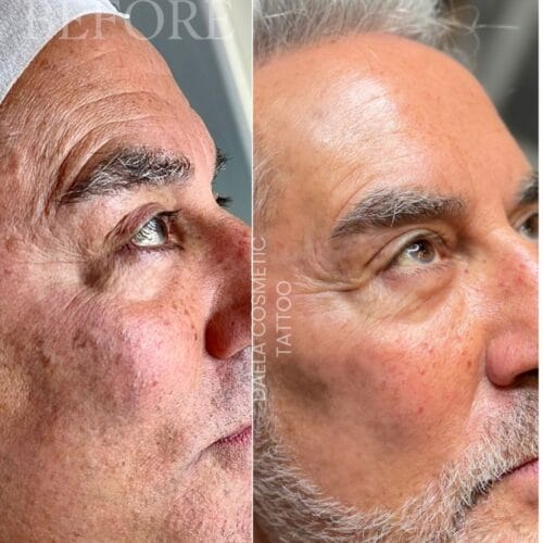 brown spot removal at daela