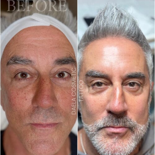 brown spot removal at daela