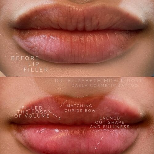 Lip Filler at DAELA Portland Dr Elizabeth McElligott