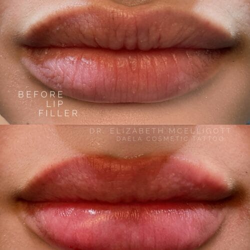 Lip Filler at DAELA Portland Dr Elizabeth McElligott