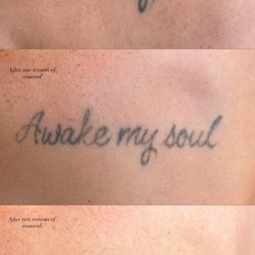 Laser Tattoo Removal at DAELA