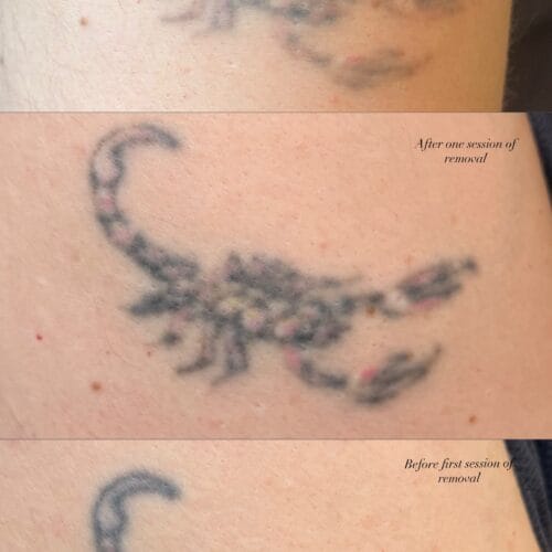 Laser Tattoo Removal at DAELA