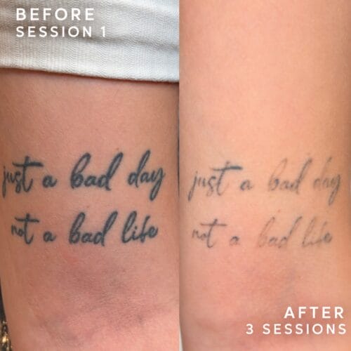 Laser tattoo Removal DAELA portland