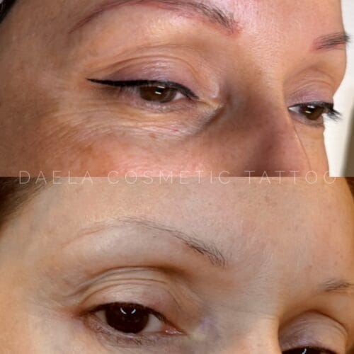 Laser PMU Removal DAELA Portland