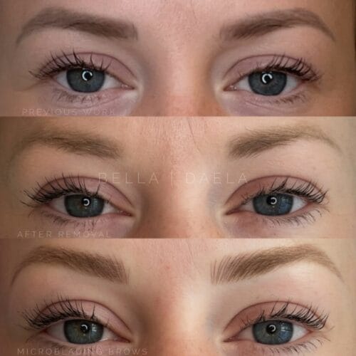 Laser PMU Removal DAELA Portland
