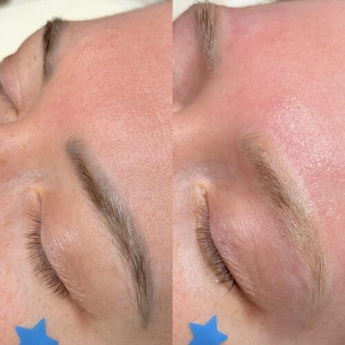 Laser PMU Removal DAELA Portland