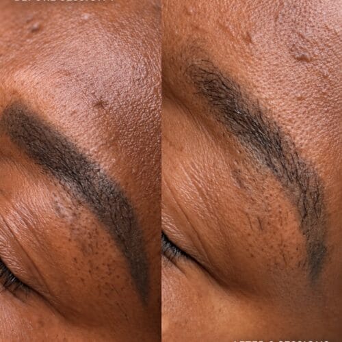 Laser PMU Removal DAELA Portland