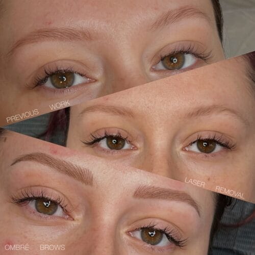 Laser PMU Removal Scottsdale at DAELA