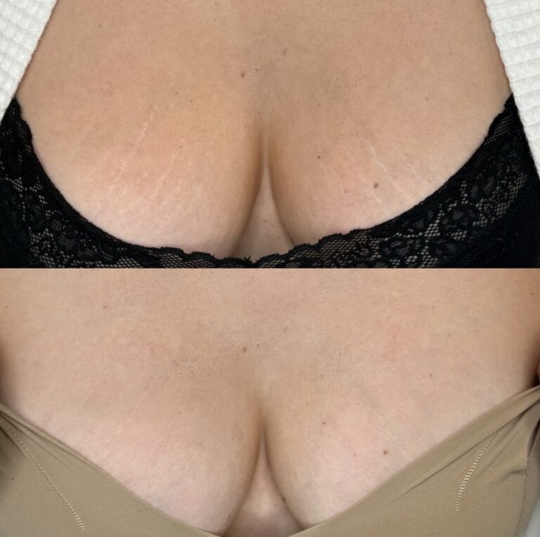 Stretch Mark Treatments in Scottsdale at DAELA Cosmetic Tattoo